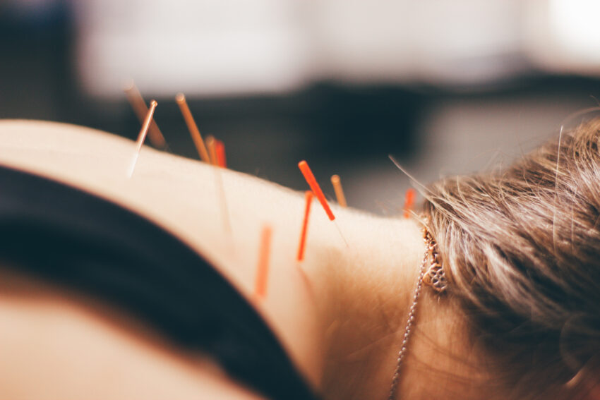 Dry Needling / Acupuncture